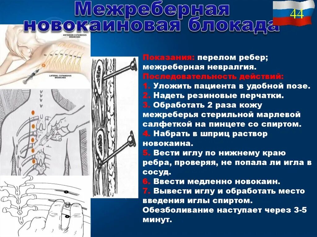 Блокада показания. Межреберная новокаиновая блокада алгоритм. Блокада межреберных нервов топографическая анатомия. Межреберная блокада техника выполнения новокаиновая. Блокада при переломе ребер.