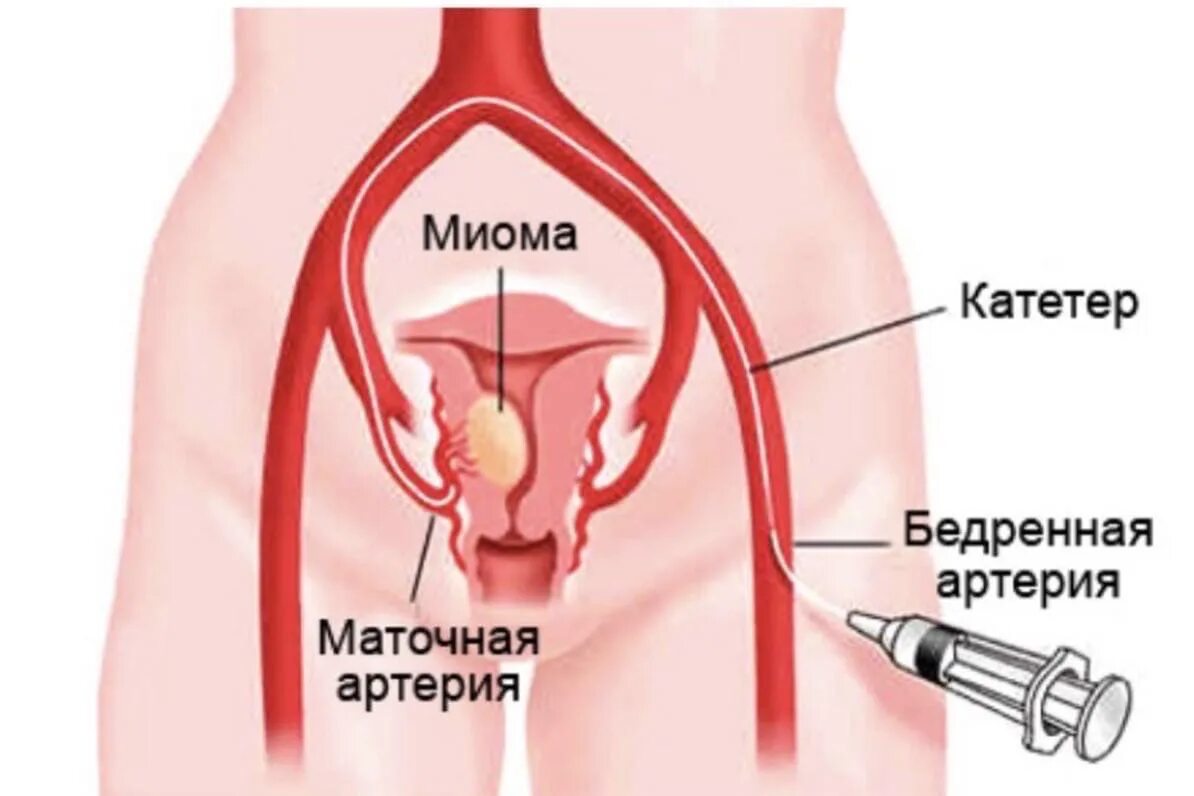 Эмболизация маточных артерий при миоме матки. Эмболизация миомы через руку. эмболизация миомы матки красноярск. окклюзия маточных артерий при миомэктомии. иммуногистохимия при лейомиоме матки.