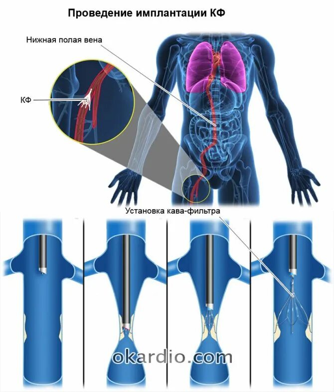 Нижняя полая Вена с кава фильтром. Кава фильтр в нижнюю полую Вену. Имплантация кава-фильтра в нижнюю полую Вену. Кава фильтр в нижней полой Вене. Тромбоз фильтры
