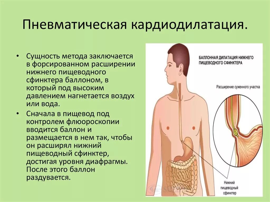 Пневматическая кардиодилатация. Баллонная кардиодилатация пищевода. Баллонный пневматический кардиодилататор. Баллонная пневматическая дилатация. Недостаток кардии