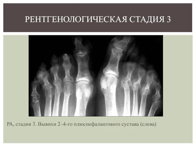 3 Рентгенологическая стадия ревматоидного артрита. Рентген картина ревматоидного артрита 2 степени. Подагрический артрит рентген стадии. Ревматоидный артрит 3 стадии рентген стоп.