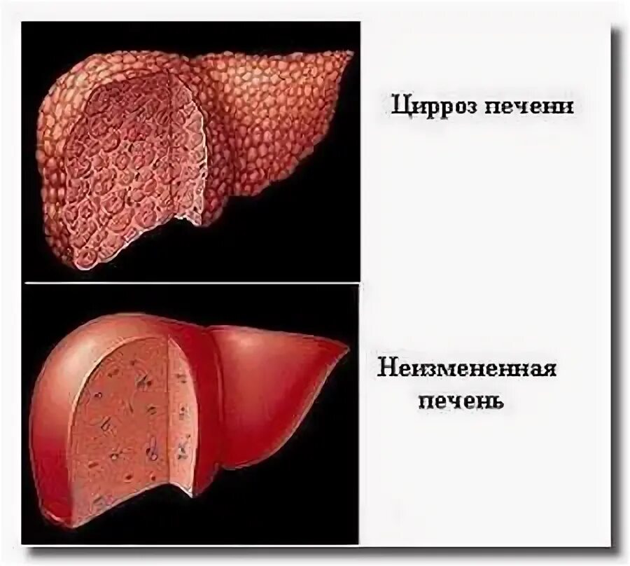 Narrowing of the fundus vessels - causes, symptoms and treatment