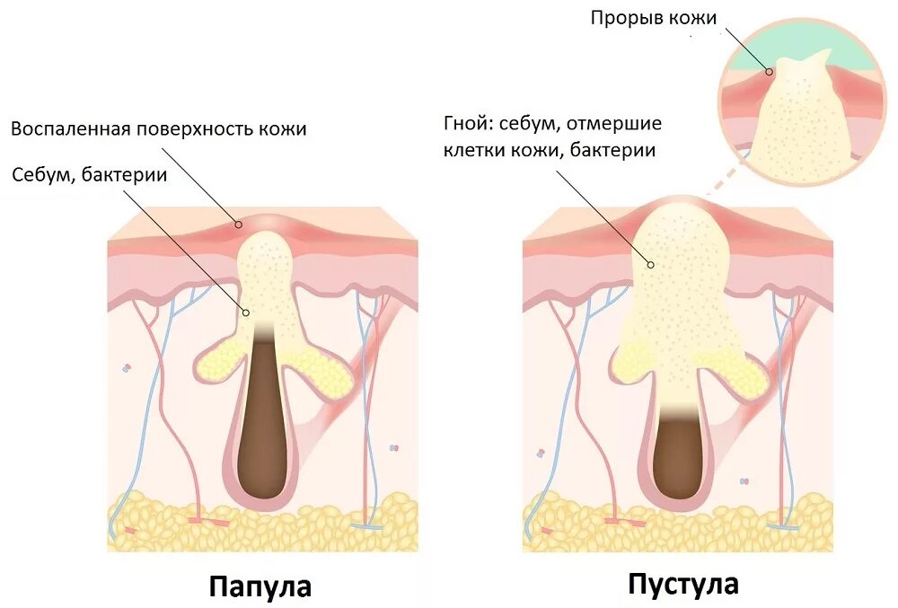 Что сделать чтобы прыщ быстрее прошел. Что сделать чтобы прыщ быстрее прошел