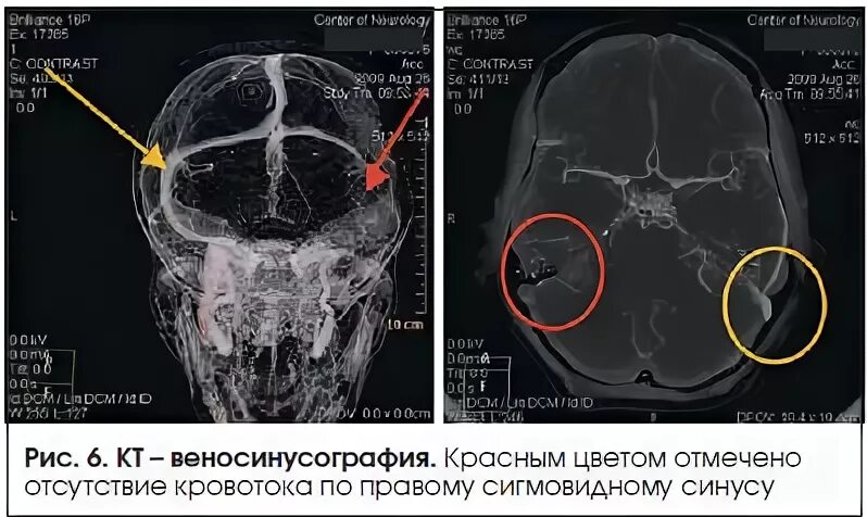Синусы мозга мрт. Тромбоз синусов головного мозга кт. тромбоз венозного синуса головного мозга кт. кавернозные синусы на кт головного мозга. тромбоз поперечного синуса головного мозга на кт.