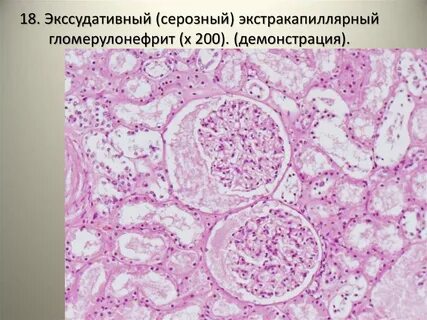 Геморрагический нефрит