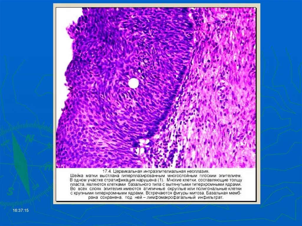 Дисплазия шейки матки микропрепарат. Многослойный плоский эпителий шейки матки гистология. Интраэпителиальная неоплазия шейки матки. Дисплазия шейки матки гистология.