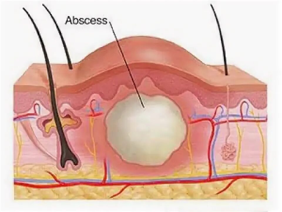 Абсцесс кожи фурункул фурункул. Фурункул карбункул абсцесс. Фурункул карбункул флегмона. Гнойное воспаление абсцесс. Неприятные отверстия