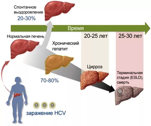 Ledviclear стопегепатит stopgepatit com. Этапы поражения печени при гепатите с. Цирроз печени стадии развития.