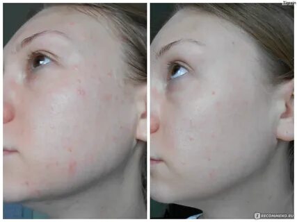 Скиноклир от прыщей