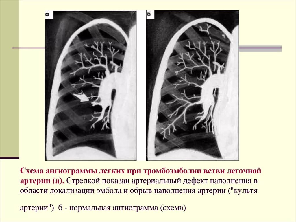 Тромбоэмболия мелких артерий. Клиника Тэла легочной артерии. Тромбоз легочной артерии на кт. Тромбоэмболия мелких ветвей легочной артерии. Клинические синдромы при Тэла.