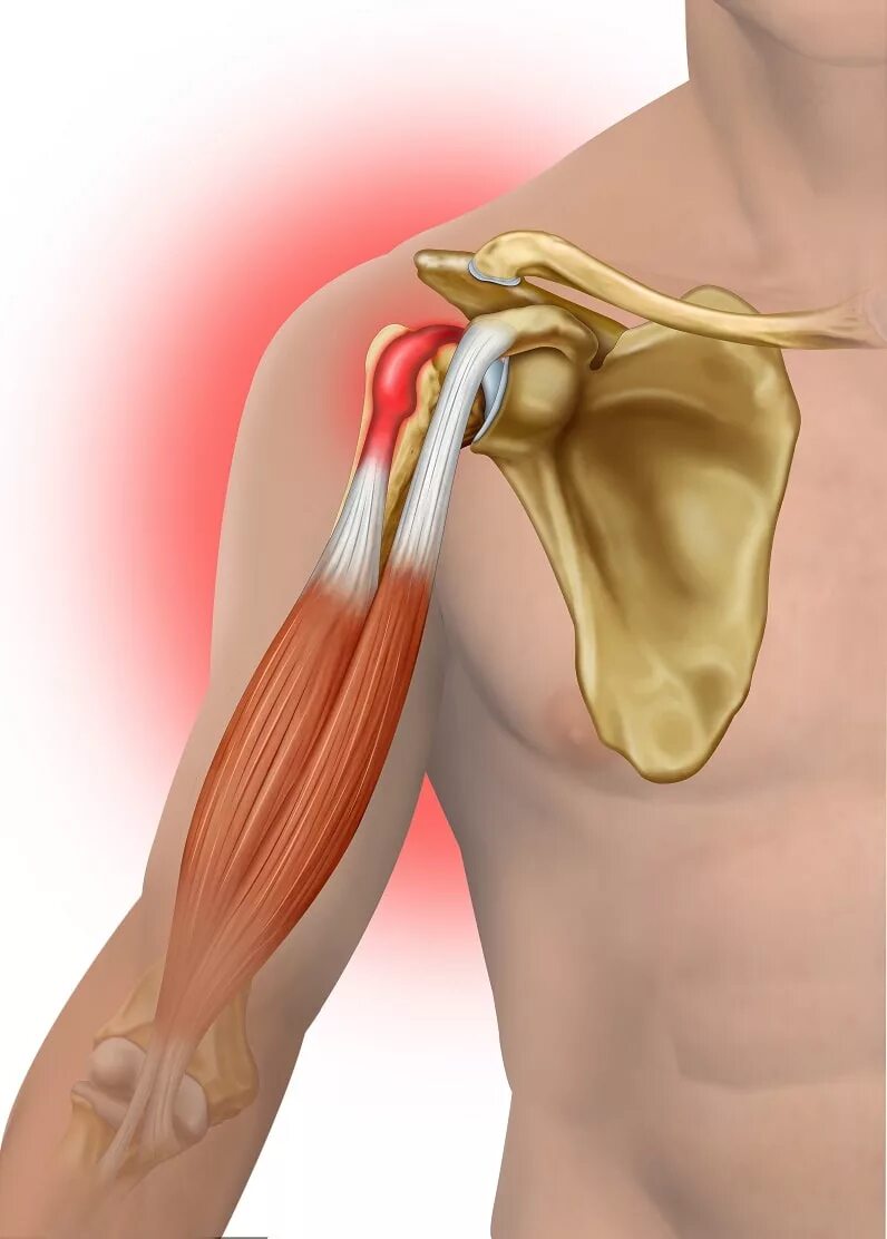 Разрыв плечевого сустава симптомы. Тендинит сухожилия бицепса плечевого сустава. Тендинит сухожилия двуглавой мышцы плеча. Тендинит — воспаление сухожилий плечевого сустава;. Тендинит сухожилия бицепса.
