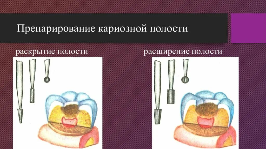 Профилактическое расширение кариозной полости. Этапы препарирования зуба. Принципы препарирования кариозных полостей по лукомскому. Препарирование кариозной полости проводят. Этап финирования краев кариозной полости.