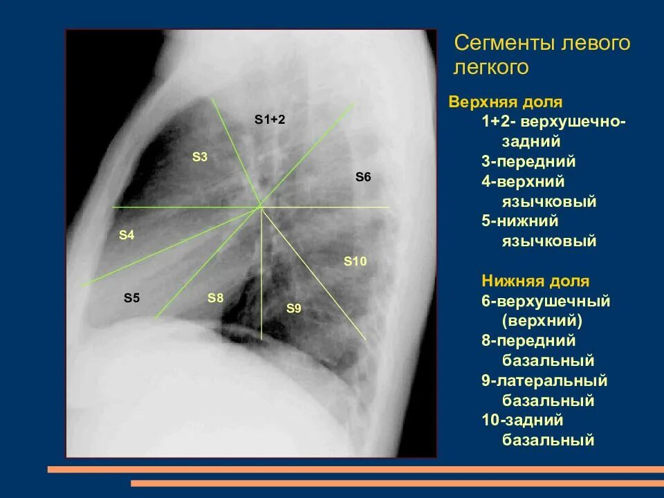 S6 в легких в правом легком. Сегмент с9 левого легкого располагается. S9 s10 левого легкого сегменты. 6, 10 Сегмент правого легкого. 6 Сегмент левого легкого.