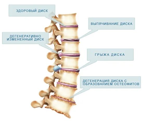 Мр дистрофических изменений пояснично крестцового отдела позвоночника. Дегенеративные изменения грудного позвоночника. Дегенеративные изменения шейного отдела позвоночника. Дегенеративные изменения грудного отдела позвоночника что это такое. Дегенеративно-дистрофические изменения позвоночника что это.