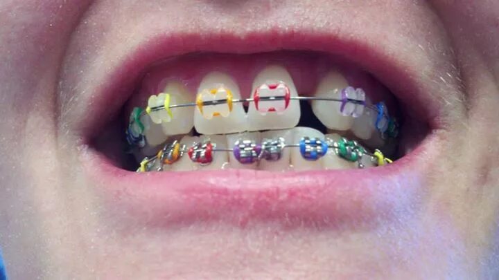 จ ด ฟ น ข น ต อ น ก อ น จ ด ฟ น (Braces 1-2-3) Power chain braces, Braces colors