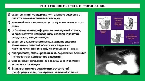 Симптом ниши