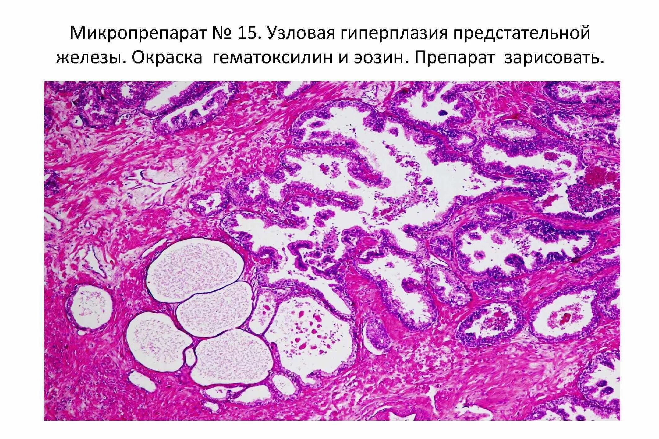 Узловая гиперплазия предстательной железы микропрепарат. Гиперплазия предстательной железы микропрепарат. Железистая гипертрофия предстательной железы микропрепарат. Доброкачественная гиперплазия предстательной железы гистология.