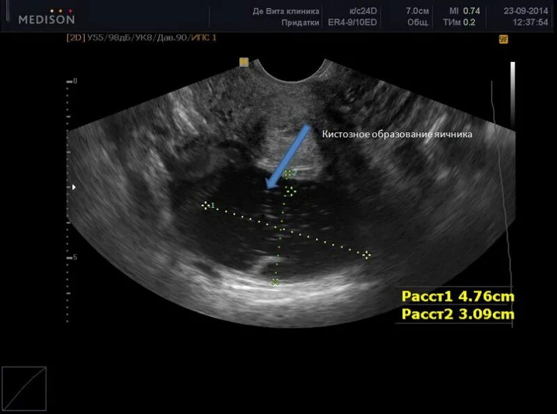 Киста малого таза у женщин узи
