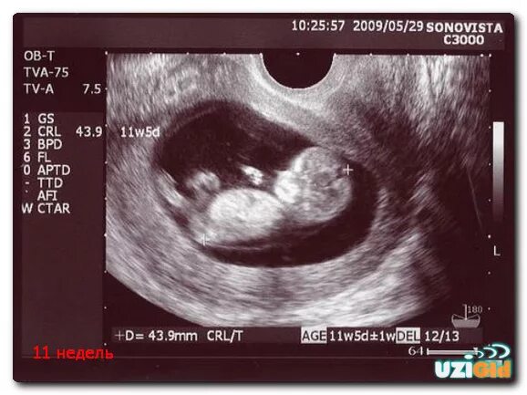 Ребенок 11 недель узи. 11 Недель беременности фото плода на УЗИ. Фото плода на 11 неделе беременности фото УЗИ. Как выглядит ребенок на УЗИ В 11 недель. Эмбрион по УЗИ 11 недель.