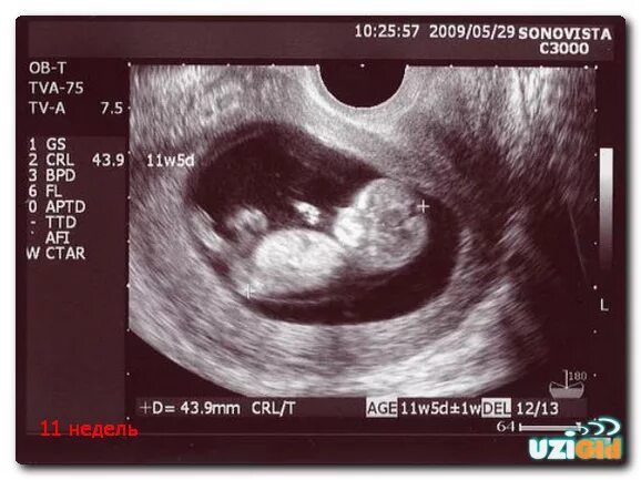 Fetal development by week: Your baby in the womb 11 weeks pregnant, Pregnancy we