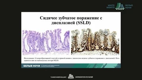 Зубчатое образование толстой кишки без дисплазии