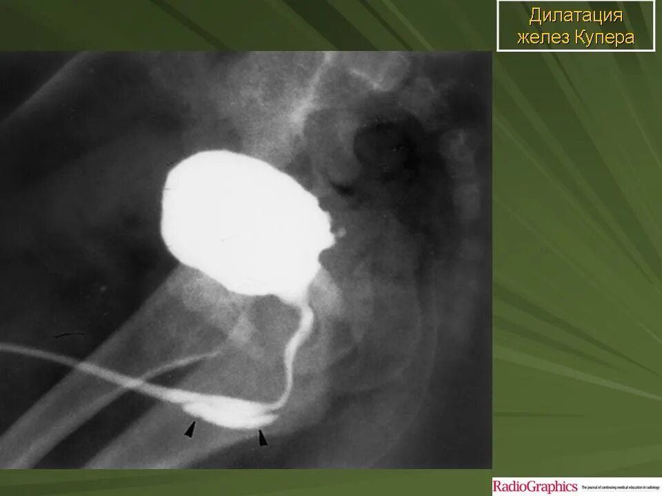 Схема лечения уретрита у мужчин. Инфекция уретры. Стержень для уретры. Схема лечения уретрита. Инфекция уретры.