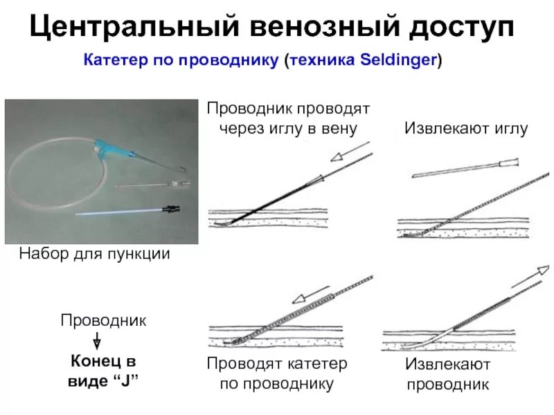 Алгоритм введения катетера. Центральный венозный катетер схема. Катетер Сельдингера. Строение центрального катетера. Центральный венозный катетер постановка схема.