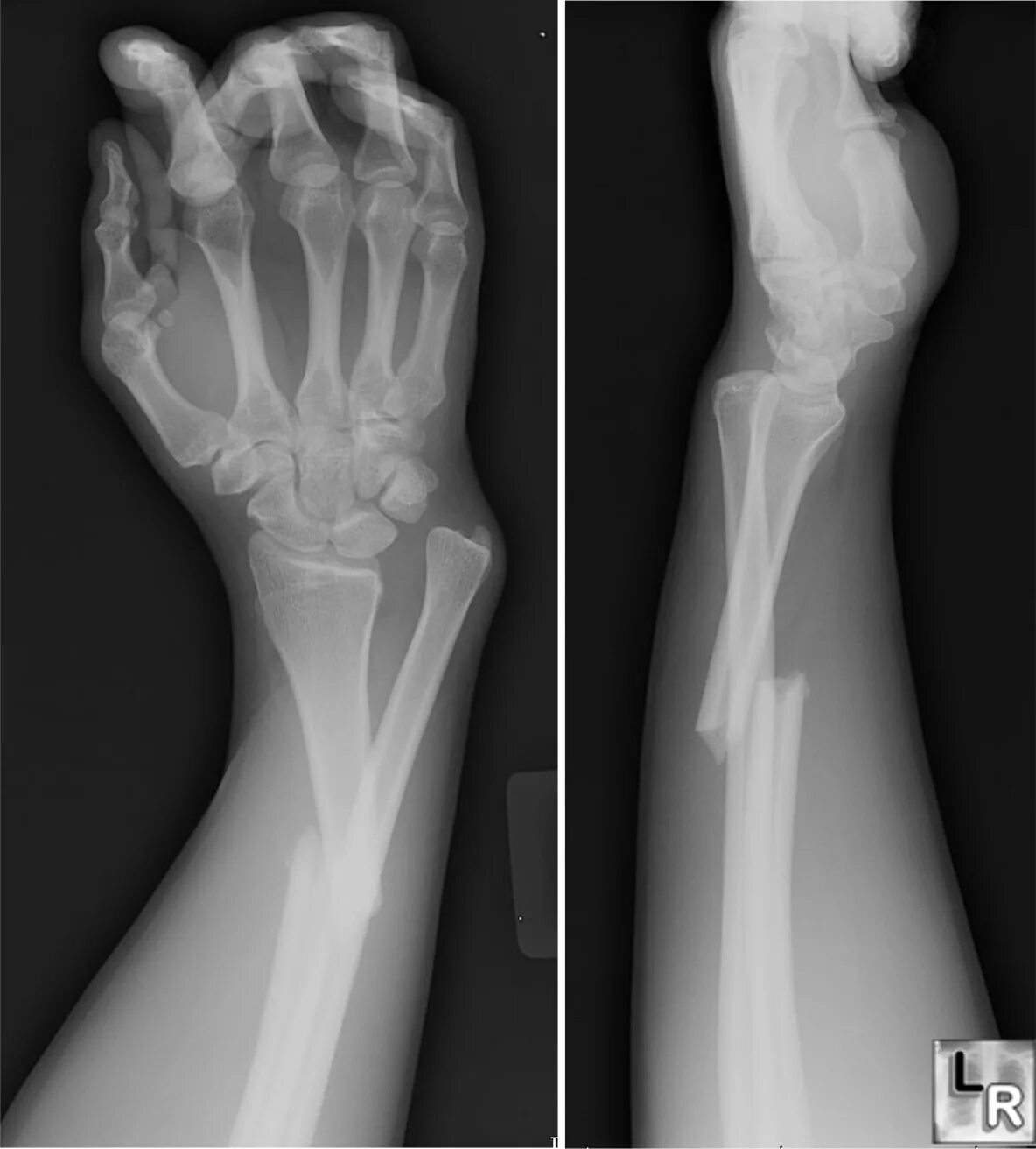 Перелом кости руки фото