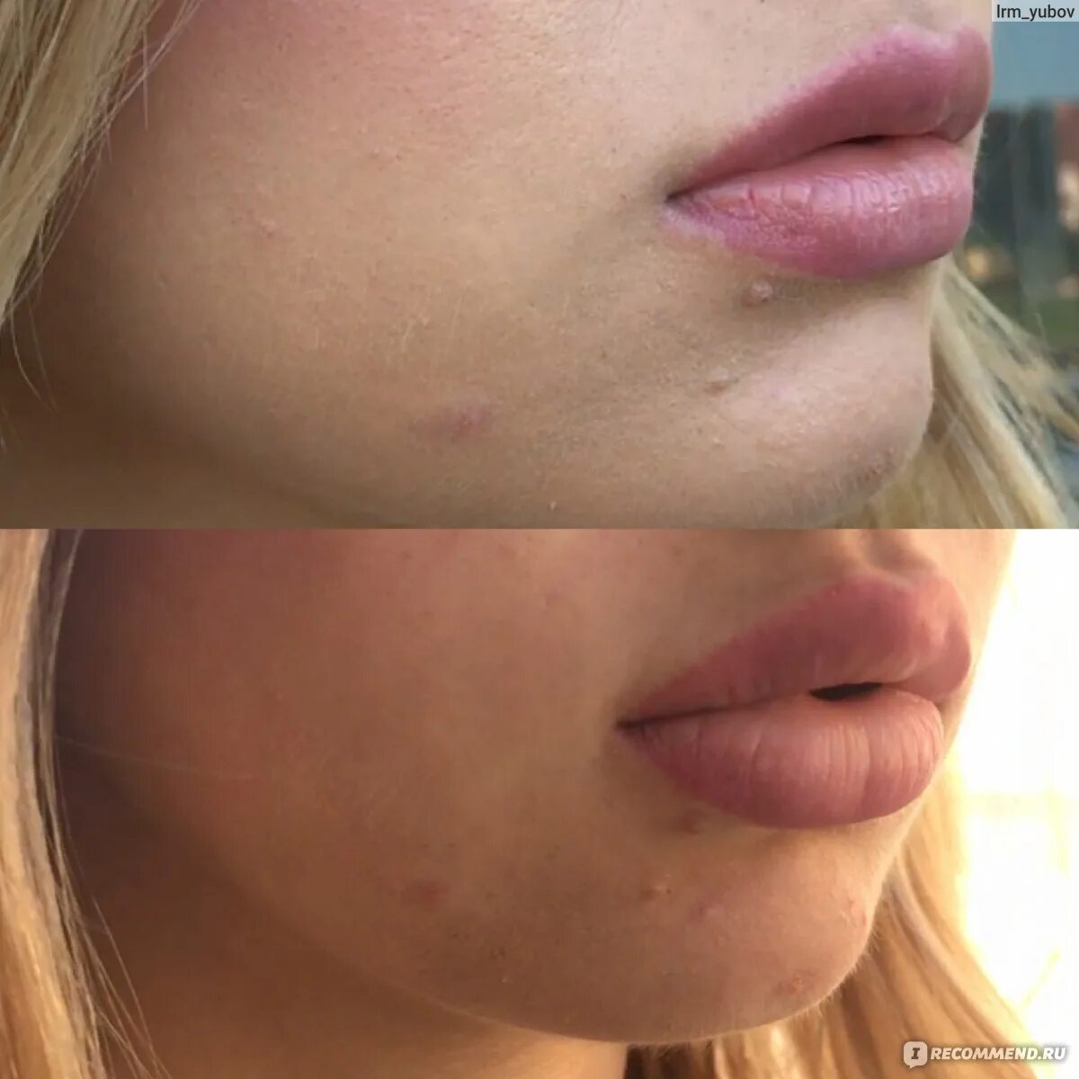 Губы после ювидерм. Juvederm ультра 3. Juvederm 3 филлер для губ. Ювидерм ультра 3 для губ.