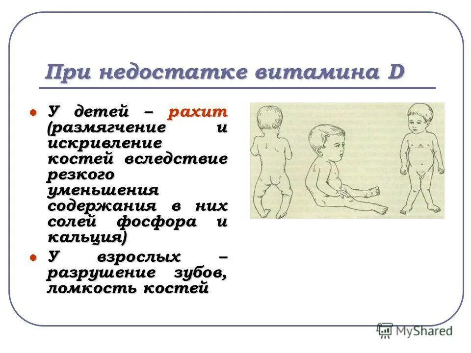 Недостаток витамина д дети рахит. Рахит при недостатке витамина д. Рахит развивается при недостатке витамина д. Нехватка витамина д симптомы у ребенка 3 месяца. Рахит вызывает недостаток витамина