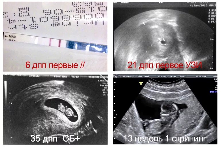 Узи первого триместра. УЗИ 1 триместр. УЗИ беременных 1 триместр. Снимок УЗИ беременность 1 триместр.