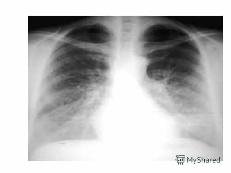 нижнедолевая пневмония рентген. рентген грудной клетки одинцово. рентгенограмма грудной клетки. рентген грудной клетки одинцово. рентген грудной клетки одинцово.