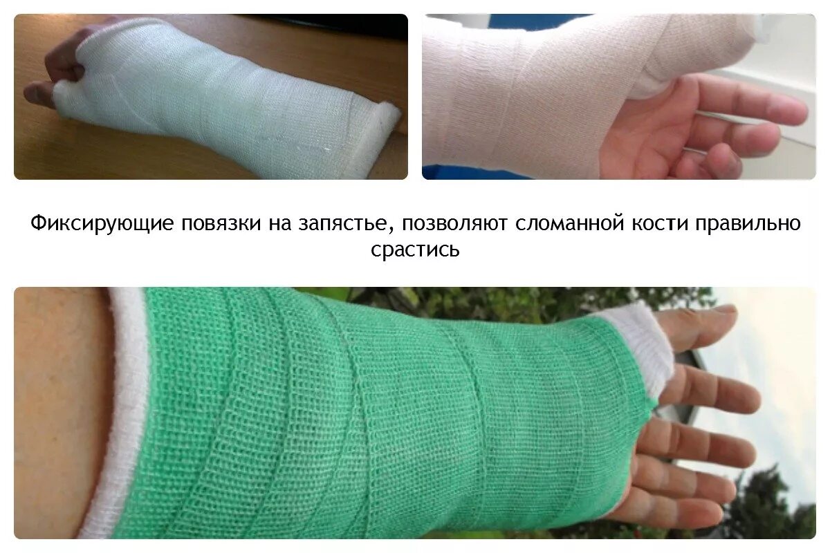 Что делают при переломах после гипса