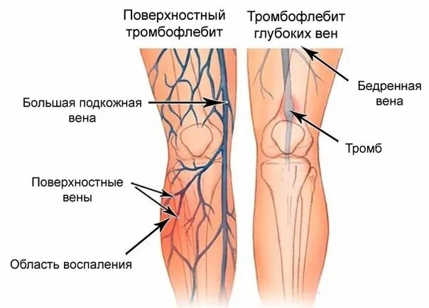 Звон в ногах. Тромбофлебит поверхностных вен - отёк. Острый тромбофлебит поверхностных вен фото. Большая подкожная Вена нижней конечности болит. Тромбофлебит икроножной мышцы.