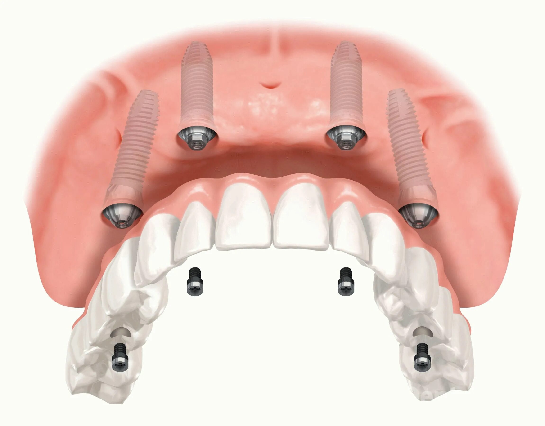 Имплантологическая кассета Nobel полный набор для all on 4. Имплантация челюсти на 6 имплантах. Имплантация челюсти на 4 имплантах.