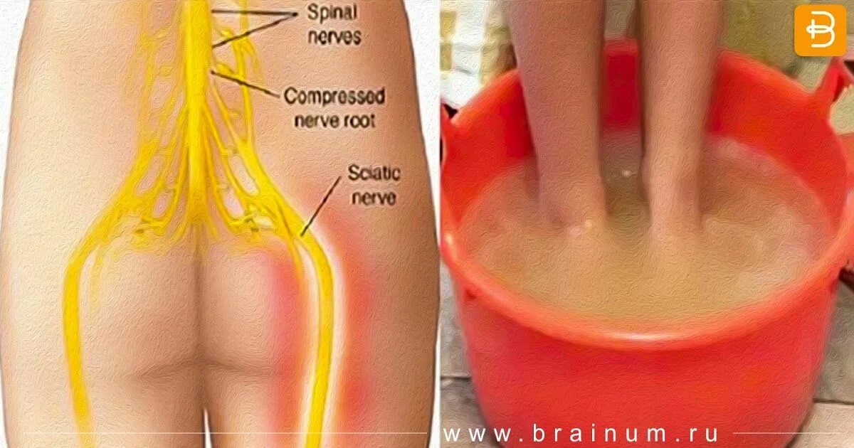 Ишиас воспаление седалищного. Седалищный нерв (sciatic nerve)? 011. Воспаление сежалищногонерва. Можно ли греть при защемлении