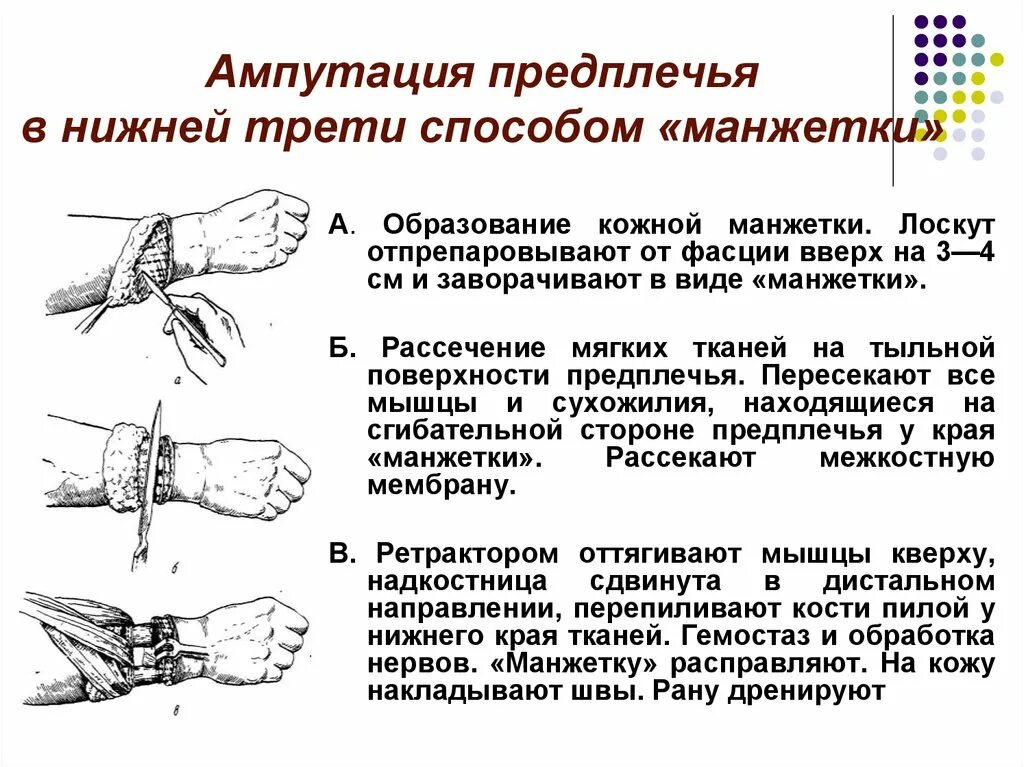 Ампутация верхней конечности на уровне ср/3 предплечья. Ампутация предплечья в нижней трети. Двухлоскутная ампутация предплечья. Ампутация с Выкраиванием Лоскутов в виде манжетки предплечья. Действия при травматической ампутации