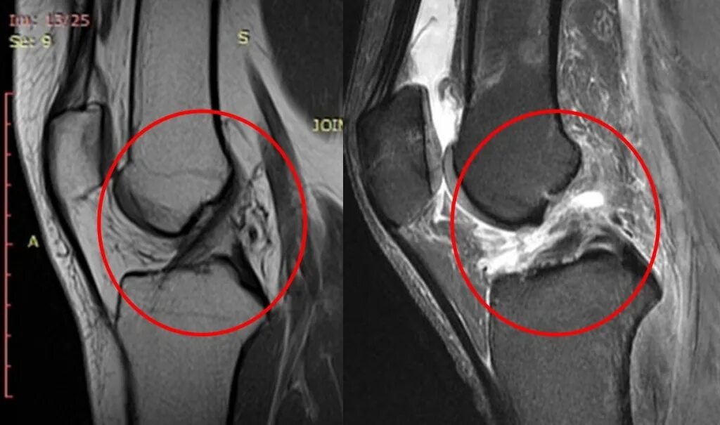 Лигаментоз передней крестообразной связки коленного сустава мрт. Гемартроз коленного сустава мрт. Гемартроз коленного сустава рентген. Разрыв крестообразной связки коленного сустава на мрт. Полный разрыв передней крестообразной