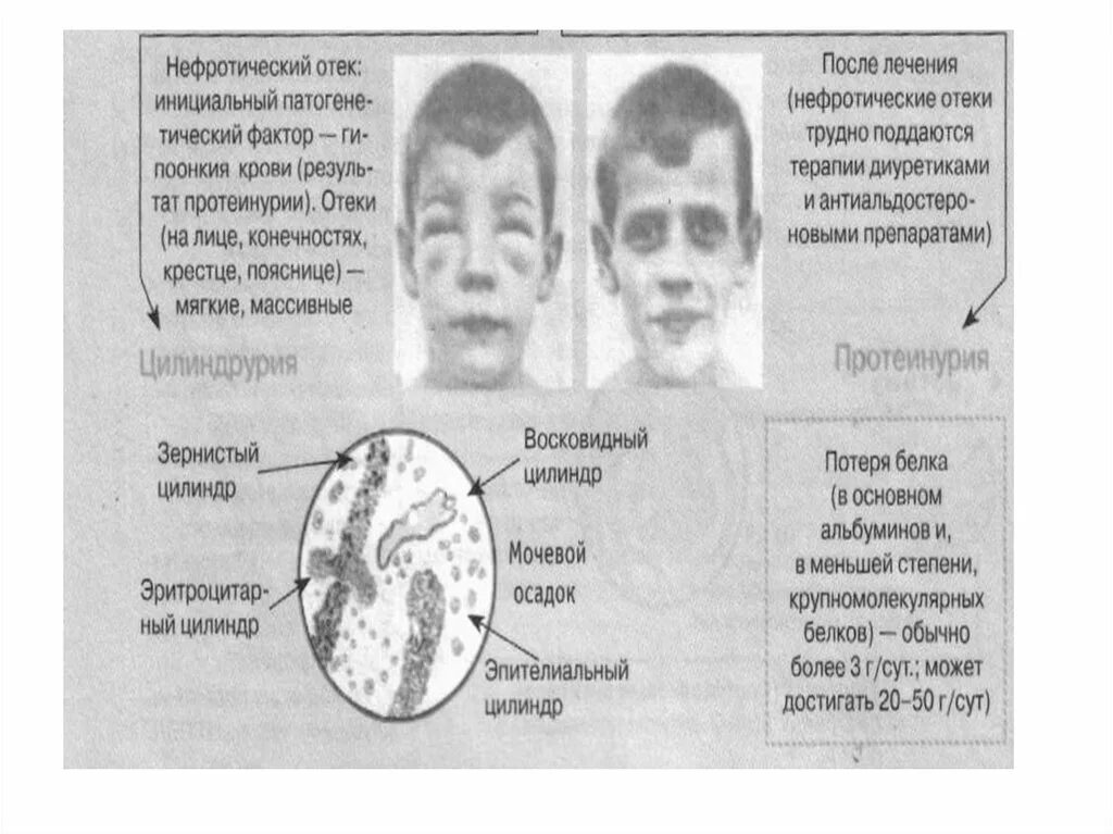 Отеки при нефротическом синдроме. Нефритический синдром отеки. Характеристика отеков при нефротическом синдроме. Отечный синдром при нефротическом синдроме.