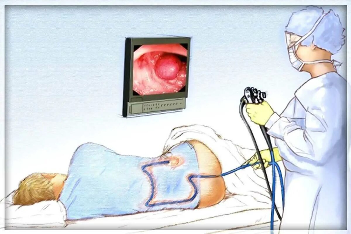 Операции через прямую кишку. Колоноскопия кишечника ФКС. Эндоскопическое исследование толстой кишки колоноскопия. Эндоскопическое исследование Толстого кишечника. Фиброколоноскопия полипы.