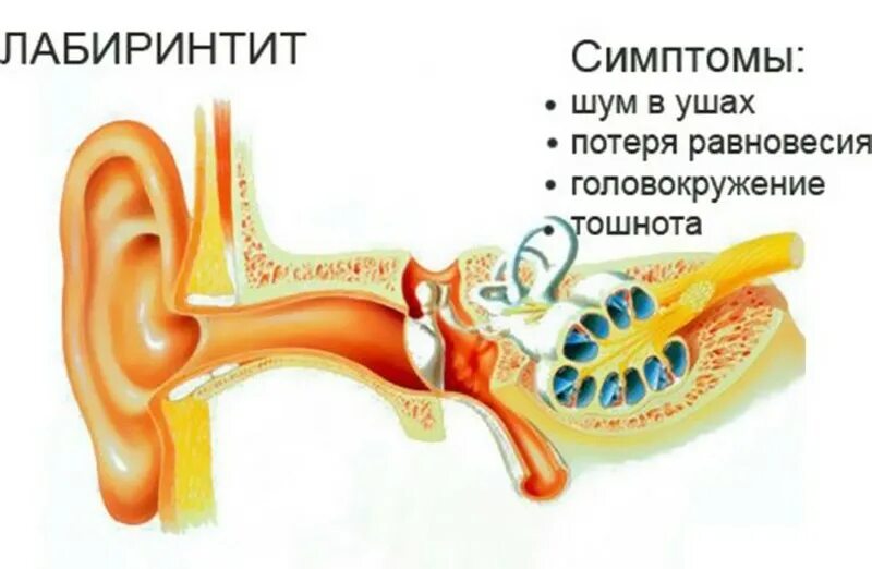 Шум в ушах клиника. Воспаление внутреннего уха (лабиринтит) возникает. Тимпаногенный лабиринтит. Воспалительные заболевания внутреннего уха (лабиринтиты).. Внутренний отит (лабиринтит).