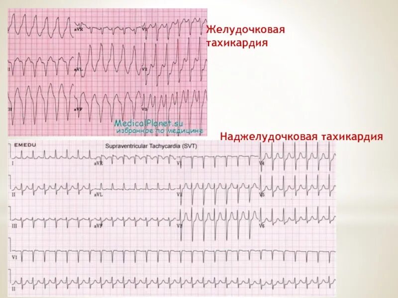 Пароксизмальная желудочковая тахикардия. Критерии наджелудочковой тахикардии. Критерии экг наджелудочковой суправентрикулярной тахикардии. Предсердная пароксизмальная тахикардия на экг. Экг при наджелудочковой тахикардии.