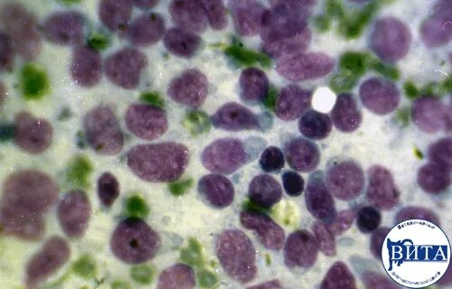 показатели анализа крови при лейкозе у кошек. возбудитель парвовирусного энтерита собак. лимфома мазок крови. проведение нефрэктомии у собаки. лейкоз у кошек показатели крови.