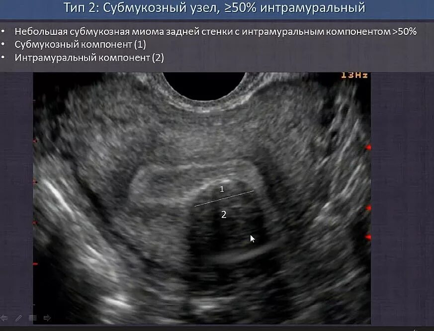 Кальцинированная миома матки на узи. Интрамуральная миома матки на узи. Интрамуральный узел задней стенки. Интрамуральный узел задней стенки. Миома интрамуральный узел.