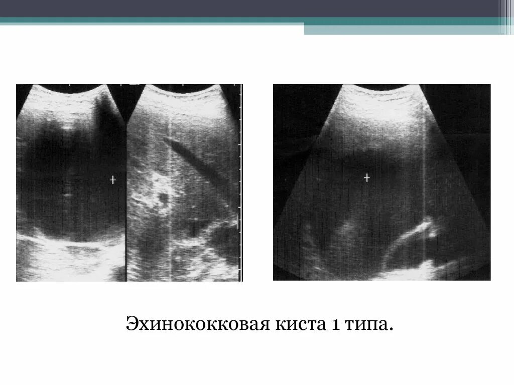 Эхинококковая киста печени УЗИ. Анэхогенные образования в печени что это такое. Анэхогенное многокамерное образование в печени что это. Эхинококковая киста почки кт. Киста левой печени