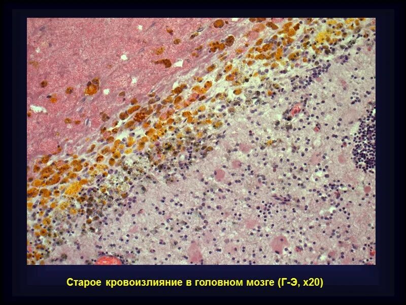 Микропрепарат головного мозга. Старое кровоизлияние в головной мозг микропрепарат. Старое кровоизлияние в мозг микропрепарат. Диапедезные кровоизлияния в мозг микропрепарат. Геморрагический инфаркт мозга микропрепарат.