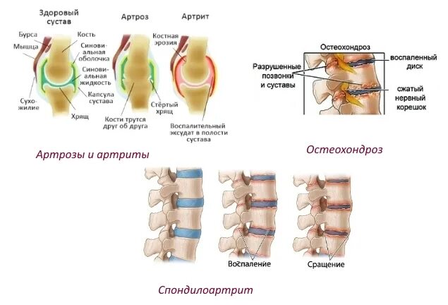 Артрит и артроз разница. Отличия артроз артрит остеохондроз. Ревматоидный артрит поясничного отдела позвоночника. Остеохондроз остеопороз остеоартроз. Остеохондроз остеоартроз разница.