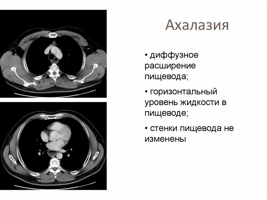 Киста пищевода. Ахалазия кардии пищевода кт. Ахалазия кардии на рентгенограмме. Утолщение стенок пищевода кт.