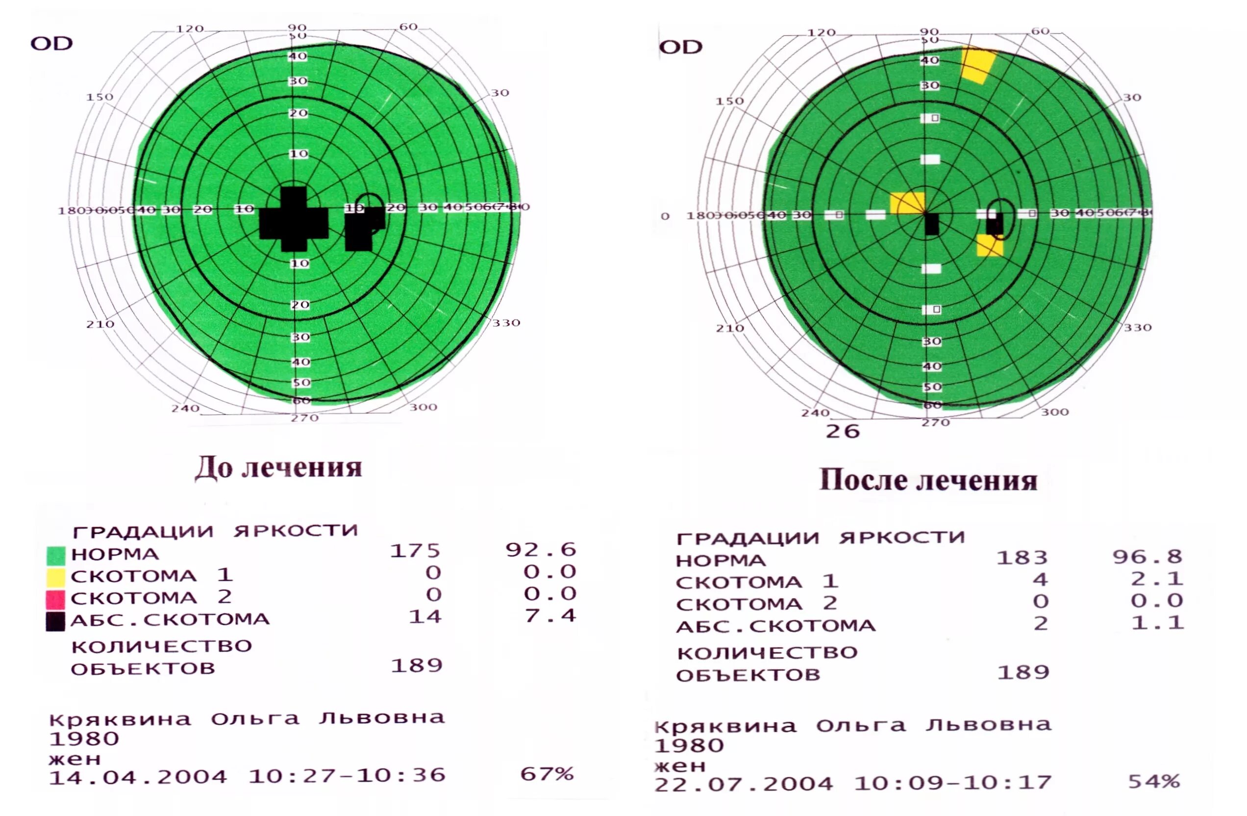 Поле зрения метод определения. Периметрия поля зрения норма. исследование полей зрения периметрия норма. поле зрения скотома и норма. тотальная периметрия глаза норма.