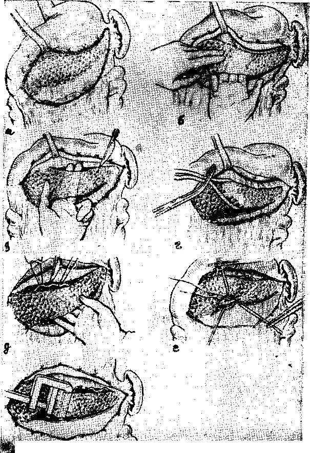 Резекция поджелудочной железы операция. Марсупиализация поджелудочной железы. Марсупиализация кисты поджелудочной железы. Этапы операции Штудера. Операция при остром панкреатите